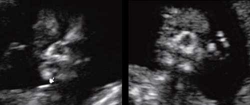 Эхограмма - нижнечелюстной промежуток плода (норма), беременность 13 недель
