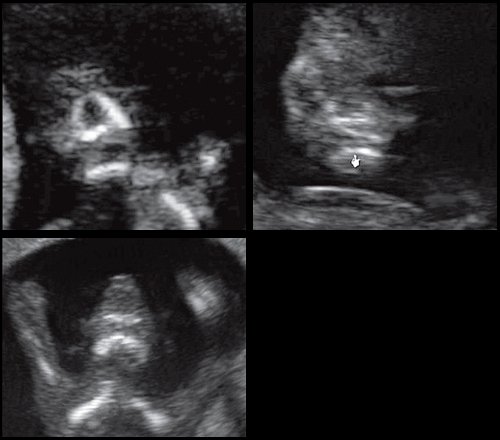 Эхограммы - отсутствие нижнечелюстного промежутка при микрогнатии, при различных синдромах нехромосомного генеза в 11-14 нед беременности
