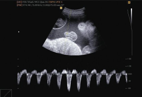 Эхограмма - нарушение гемодинамики II плода (реверсный кровоток в артерии пуповины)