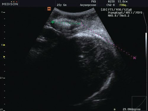 Трансперинеальное УЗИ - угол прогрессии равен 151°, роды через естественные родовые пути возможны