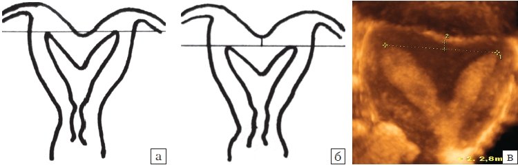 Двурогая матка: а,б - схематическое изображение; в - 3D эхограмма (коронарная плоскость)