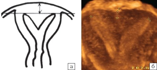Матка с вертикальной перегородкой: а - схематическое изображение, б - 3D эхограмма (коронарная плоскость)