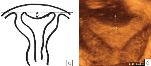Седловидная матка: а - схематическое изображение, б - 3D эхограмма (коронарная плоскость)