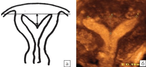 Матка с вертикальной перегородкой: а - схематическое изображение,б - 3D эхограмма (коронарная плоскость)
