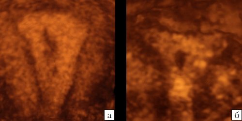 Эхограмма (3D) - неполные перегородки в матке, не связанные с дном (а, б)