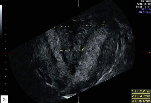 Эхограмма - неполная вертикальная перегородка в матке до операции, ширина перегородки на разных уровнях