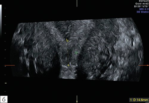 Эхограмма - неполная вертикальная перегородка в матке до операции, размеры общей полости