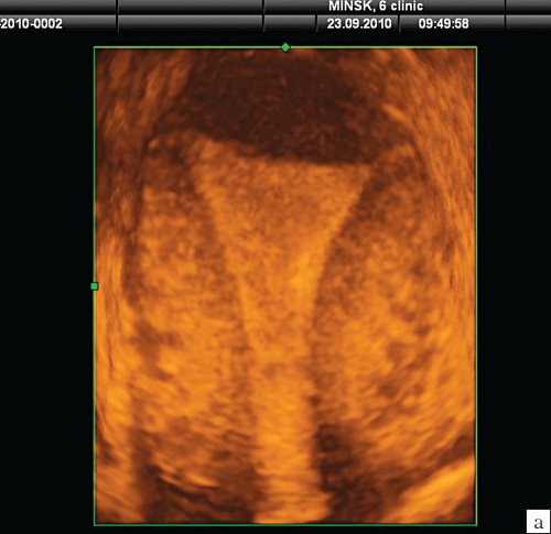 Эхограмма - полость матки, 1 фаза цикла (3D, коронарная плоскость)