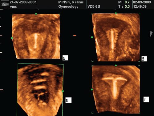 Эхограмма - полость матки с ВМК (3D, коронарная плоскость), а - кольцевидная ВМС, б - спираль Купер-Т, в - спираль Липса, г - Т-образная внутриматочная спираль