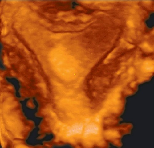Эхограмма - полип эндометрия (3D, коронарный срез)