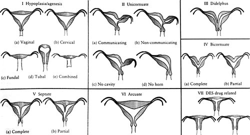 Классификация пороков женских внутренних половых органов