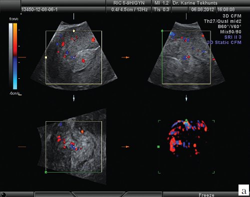 Эхограмма - характер неoваскуляризации в области инвазии в миометрий (режим 3D, CFM)
