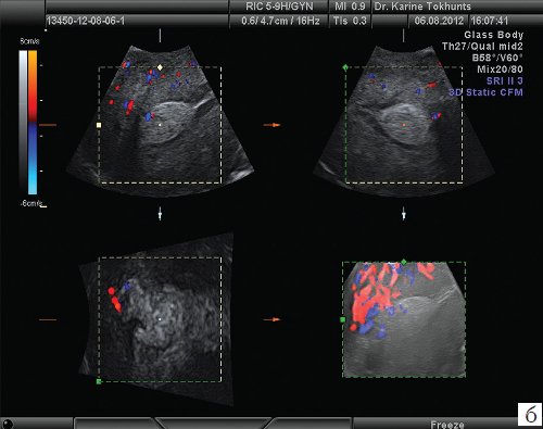 Эхограмма - характер неoваскуляризации в области инвазии в миометрий (режим Glasse body)