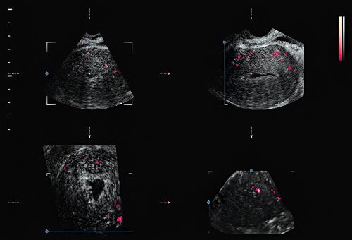 Трансвагинальное сканирование - 3D изображение матки (режим энергетического допплера)