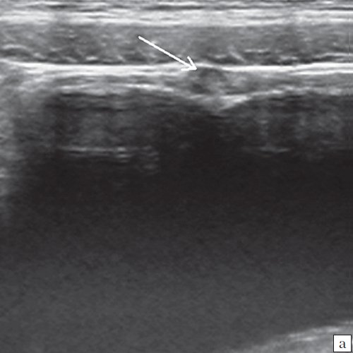 Эхограмма урахуса (стрелка) в области верхушки мочевого пузыря (поперечная плоскость сканирования)