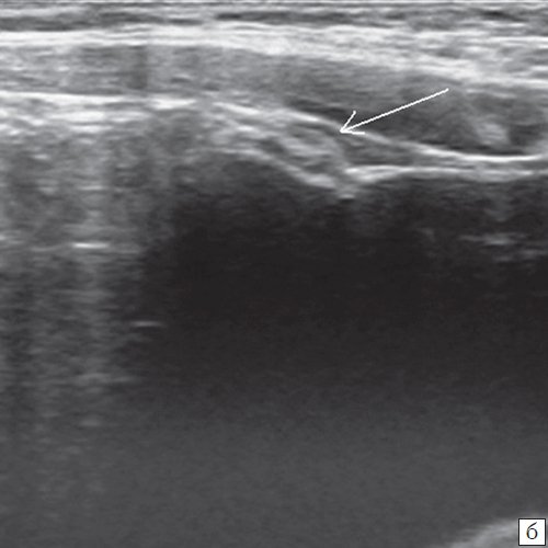 Эхограмма урахуса (стрелка) в области верхушки мочевого пузыря (продольная плоскость сканирования)