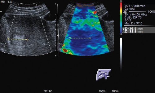 Эластография с ручной компрессией (режим цветового кодирования) - метастаз в правой доле печени жесткой консистенции, QF=65