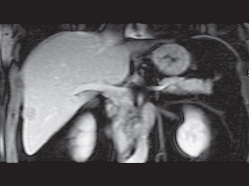 МРТ метастаза в печени - корональная проекция