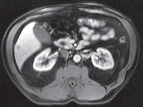 МРТ метастаза в печени, артериальная фаза