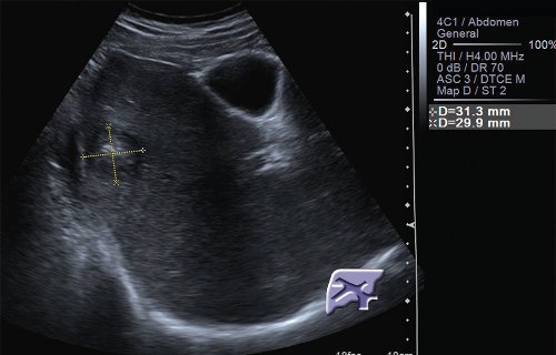 УЗТ метастаза колоректального рака в правой доле печени, В-режим