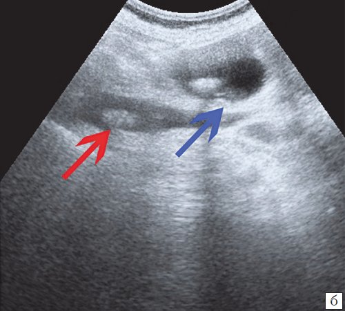 УЗ-картина конкрементов - конкременты в холедохе (красная стрелка) и в желчном пузыре (синяя стрелка)