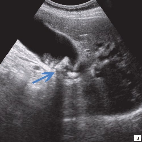 УЗ-картина конкрементов - конкременты в желчном пузыре