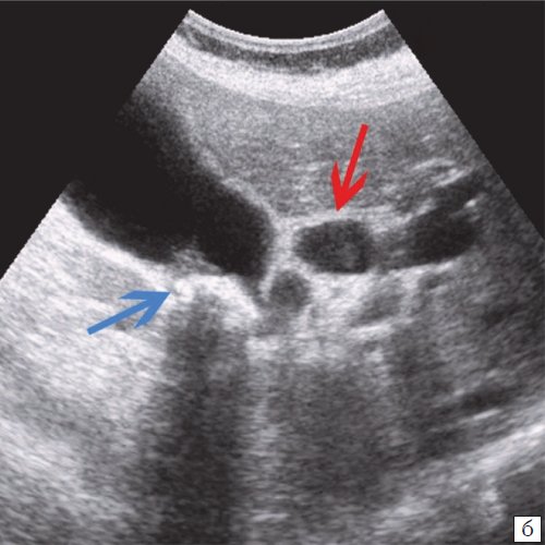 УЗ-картина конкрементов - конкременты в желчном пузыре (синяя стрелка) и расширенный холедох (красная стрелка)