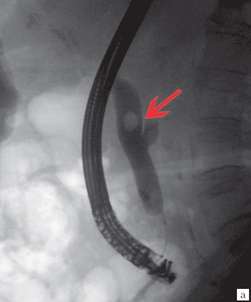 Эндоскопическая ретроградная холангиопанкреатография - конкремент в холедохе