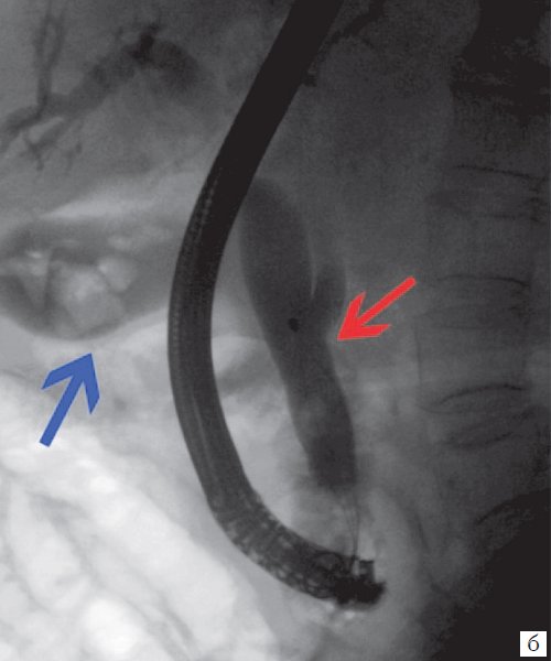 Эндоскопическая ретроградная холангиопанкреатография - конкременты в желчном пузыре (синяя стрелка), в холедохе (красная стрелка)