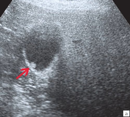 Эхограмма - одиночный полип в желчном пузыре (2а)