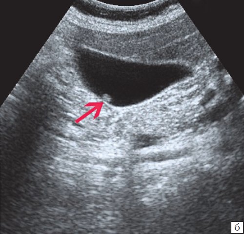 Эхограмма - одиночный полип в желчном пузыре (2б)