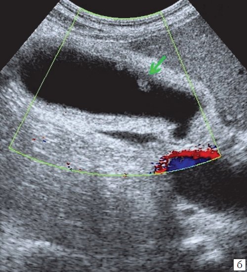 УЗ-картина полипов в желчном пузыре - режим ЦДК, кровоток не регистрируется