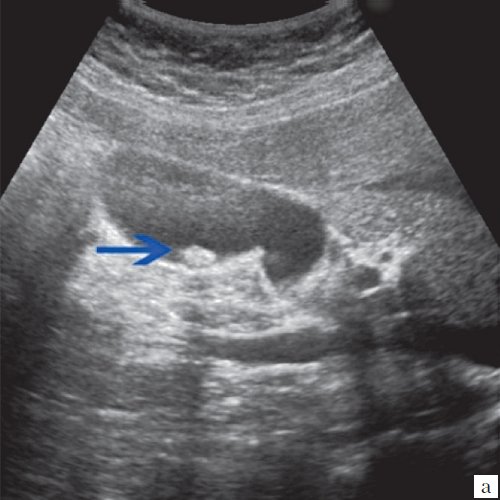 Эхограмма - одиночный конкремент желчного пузыря