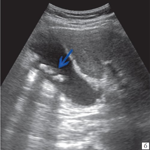 Эхограмма - множественные конкременты желчного пузыря (4б)