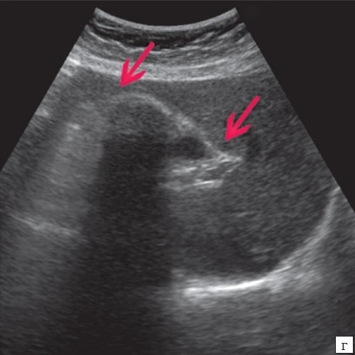 Эхограмма - отключенный (полностью заполненный конкрементами) желчный пузырь, уменьшение размеров желчного пузыря (сморщивание)