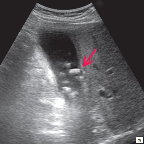 Эхограмма - множественные конкременты желчного пузыря (4в)