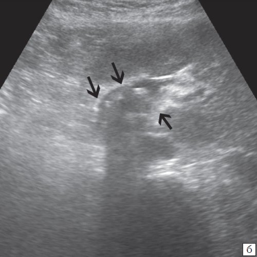 УЗ-картина холедохолитиаза - в просвете общего желчного протока множественные гиперэхогенные структуры различного диаметра, дающие четкую акустическую тень