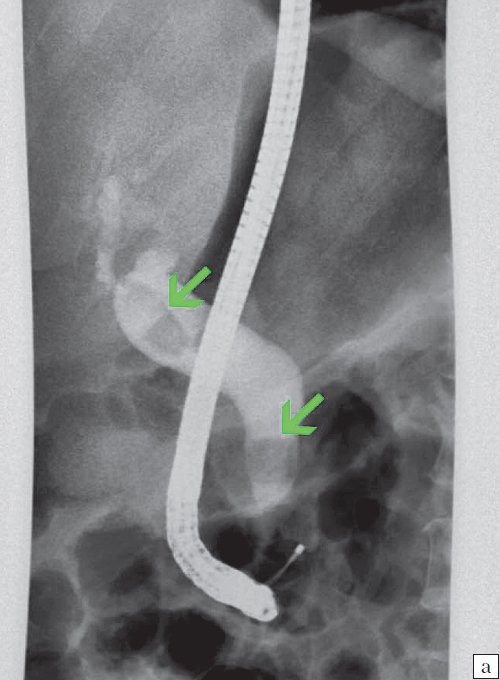 Эндоскопическая ретроградная холангиопанкреатография- конкременты холедоха (6а)
