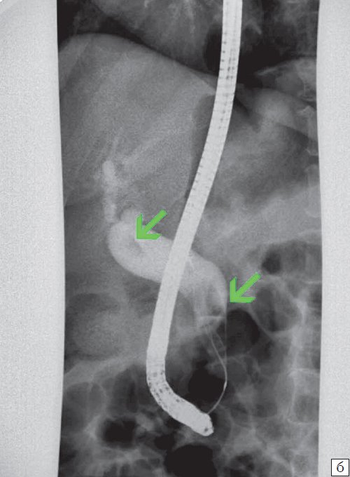 Эндоскопическая ретроградная холангиопанкреатография- конкременты холедоха (6б)