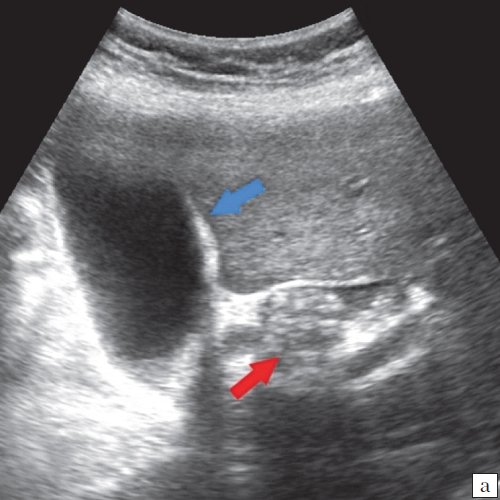 УЗ-картина холедохолитиаза - увеличенный желчный пузырь (синяя стрелка), конкременты общего желчного протока (красная стрелка)