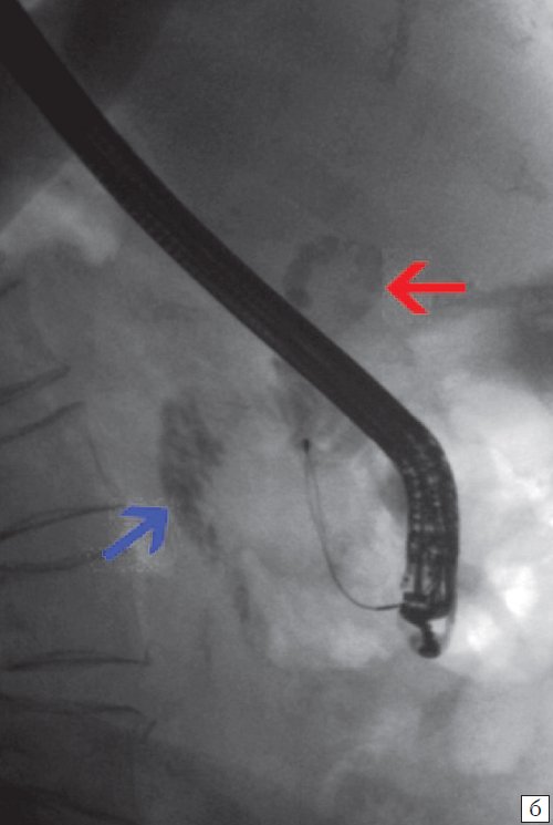 Эндоскопическая ретроградная холангиопанкреатография - холедох с конкрементами (красная стрелка), сброс контраста в кишку (синяя стрелка)