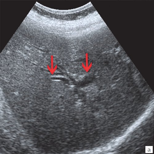 УЗ-картина расширения внутрипеченочных протоков