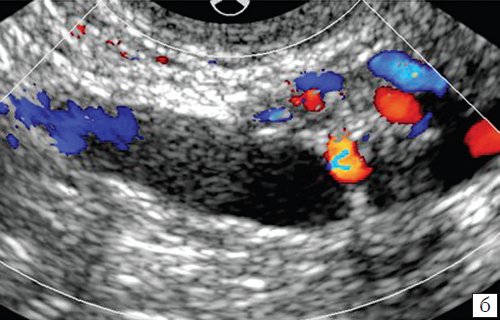 ТВУЗИ - в просвете расширенной вены левого параметрального сплетения в режиме ЦДК окрашивания просвета сосуда не происходит