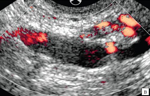 ТВУЗИ - в просвете расширенной вены левого параметрального сплетения в режиме энергетического картирования окрашивания просвета сосуда не происходит