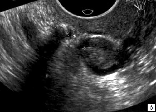 ТВУЗИ - слева от матки в просвете вены визуализируется флеболит, в просвете расширенной вены визуализируется тромб средней эхогенности