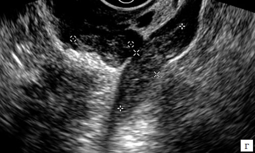 ТВУЗИ - в просвете расширенных извитых вен параовариальных сплетений визуализируются множественные слабоэхогенные фиксированные тромбы
