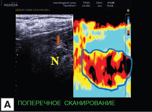Эластография - злокачественное образование в щитовидной железе, поперечное УЗ-сканирование