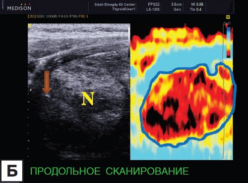 Эластография - злокачественное образование в щитовидной железе, продольное УЗ-сканирование