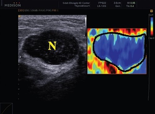 Эластография - доброкачественная киста щитовидной железы