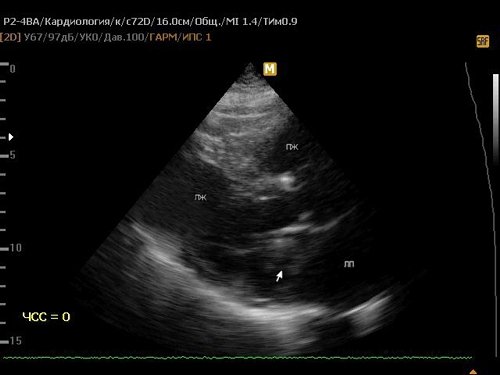 Эхограмма - флотирующая миксома левого предсердия (2)